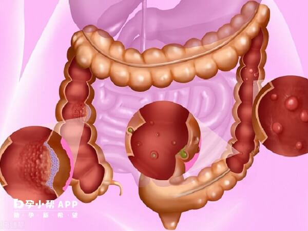 家族性胃肠道息肉是常染色体显性遗传病