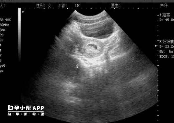 怀孕早期做B超是需要憋尿的
