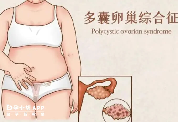 多囊卵巢综合症也能怀孕