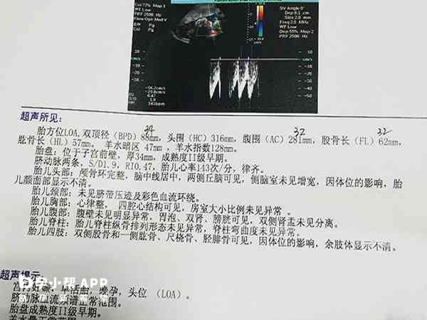 双顶径在10cm以下可以顺产