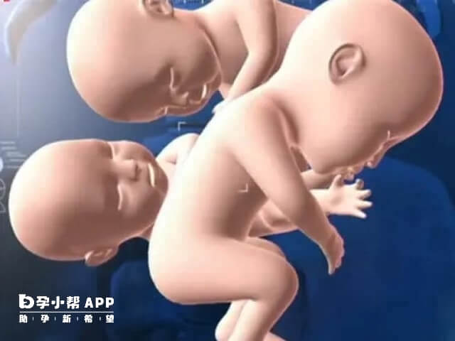 怀三胞胎孕期风险高