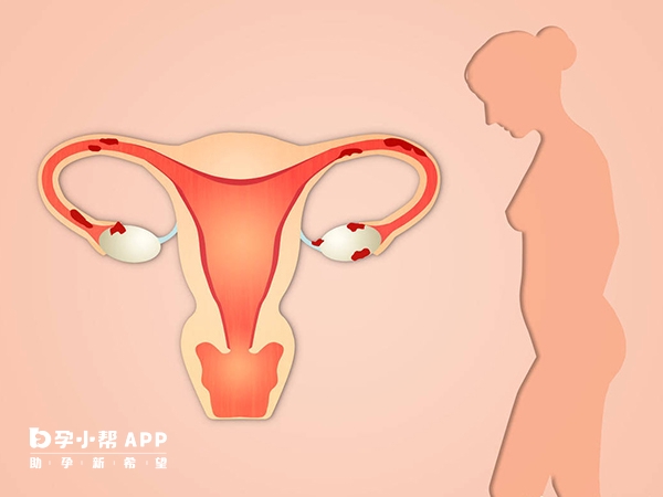 输卵管堵塞程度影响怀孕