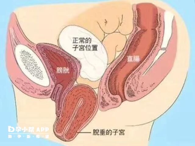 子宫脱垂影响生育