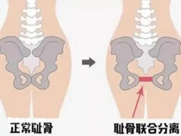 孕妇耻骨的具体位置在小腹最下方