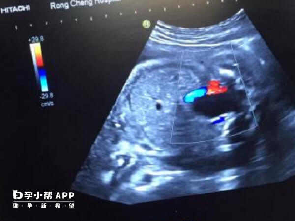 胎儿有两根脐动脉是正常现象