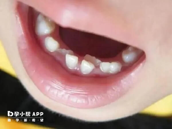 长期使用奶嘴会导致牙齿排列不整齐