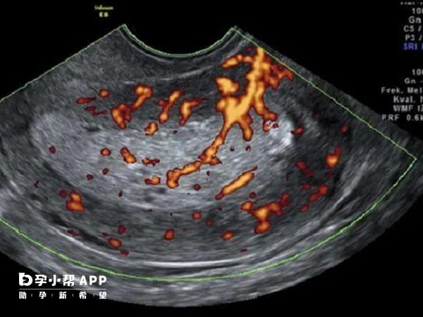 B超检查可以评估子宫内膜厚度和血液供应