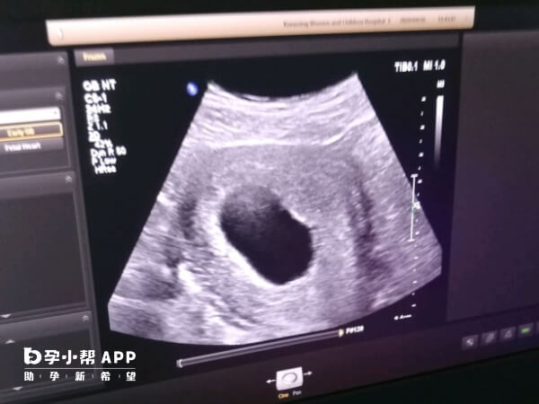 空囊指胚胎移植后没有长出来的胚胎