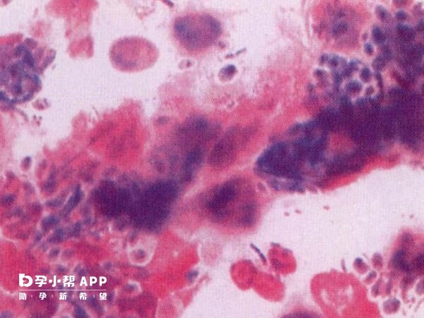 白带常规检查有霉菌需要延后移植胚胎
