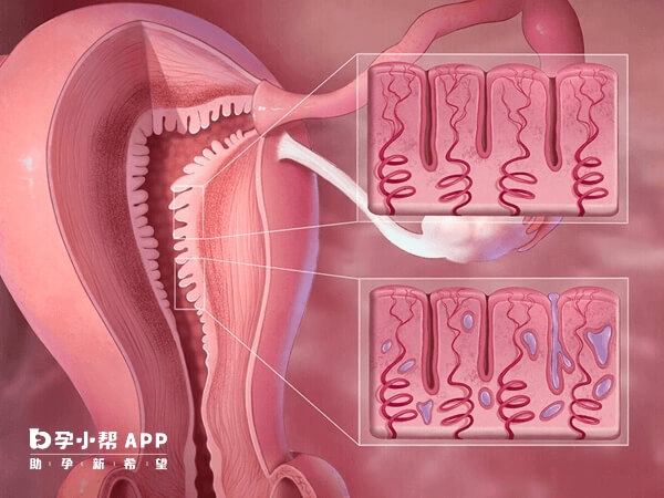 子宫内膜厚度是做人工受孕的必查项目