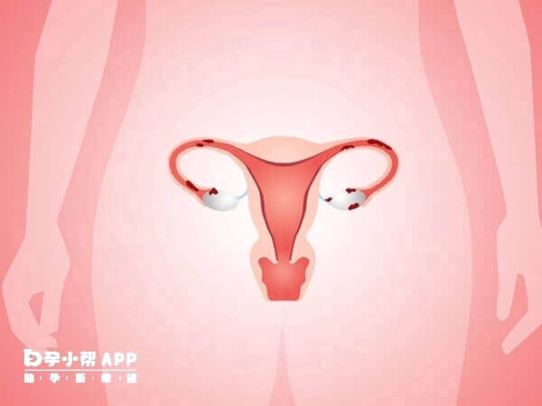多囊卵巢的生殖技术选择看个人情况