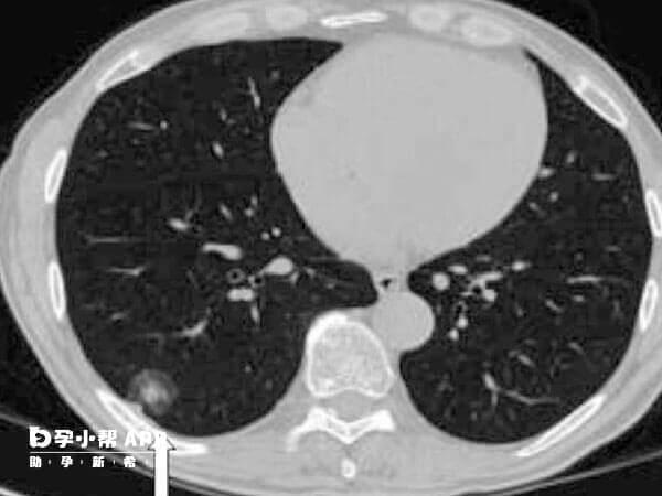 肺结节密度正常癌变的风险较低