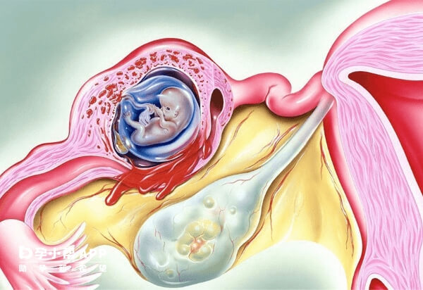 宫外孕者需要通过相应的方法终止妊娠