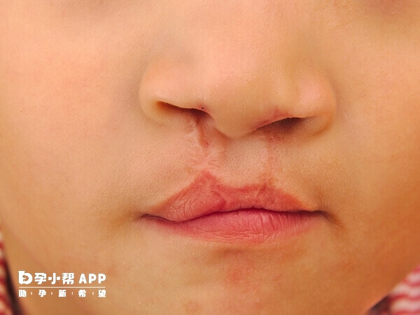 家族中有唇腭裂病史后代患病概率大