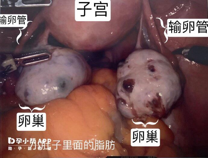 腹腔镜下的子宫和卵巢