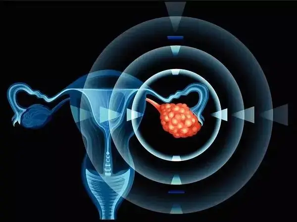 微刺激方案能减少对卵巢的刺激