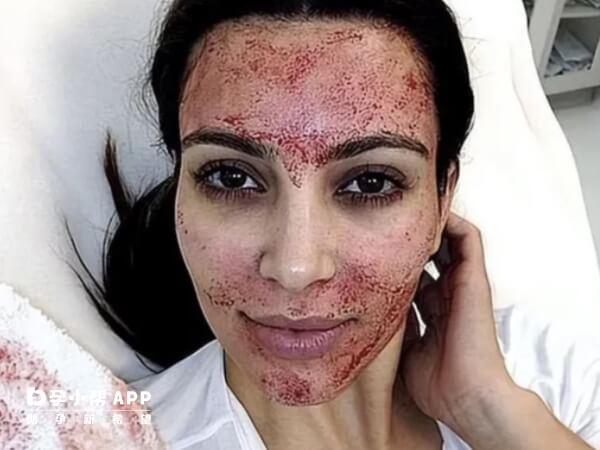 卡戴珊晒吸血鬼面膜后脸部图片