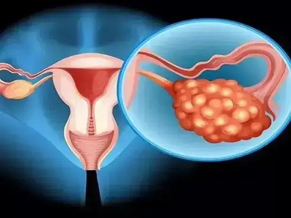 卵巢囊肿会影响受精过程