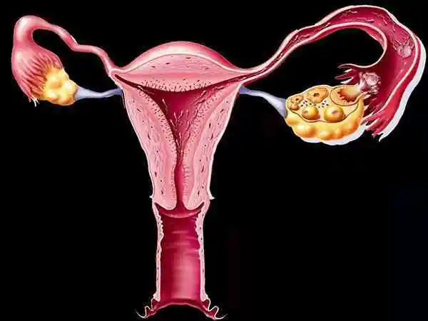 输卵管堵塞是不孕常见原因