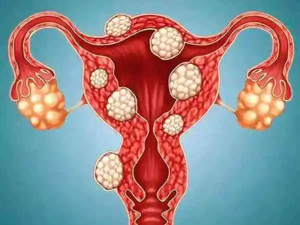 输卵管堵塞先治疗可以自然怀孕