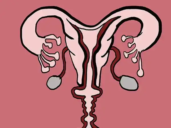 输卵管堵塞会引起不孕症