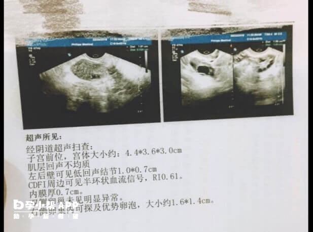 B超检查是做试管重要环节