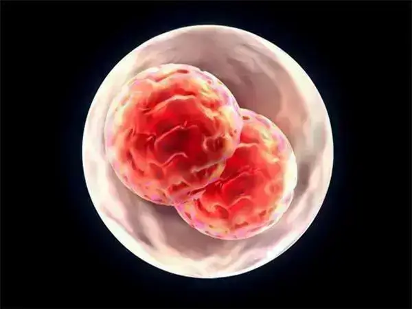 试管婴儿多个胚胎移植易导致多胎妊娠