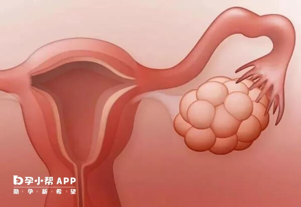 多囊卵巢可能会引起不孕