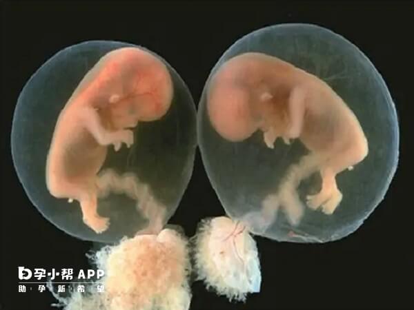 试管婴儿生双胎的可能性高