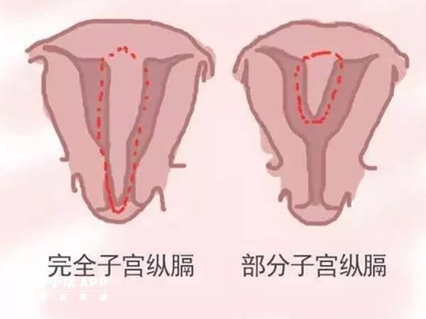 纵隔子宫试管移植双胎会导致难产