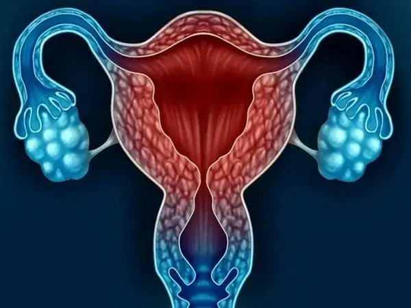 子宫内膜异位症试管婴儿成功率最低30%