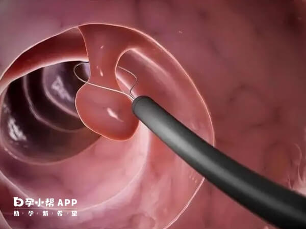子宫内膜息肉可能会影响试管