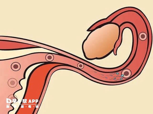 输卵管造影能检查出是否有子宫纵膈