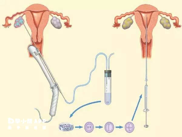 冻胚移植的取卵手术通常在3至5天
