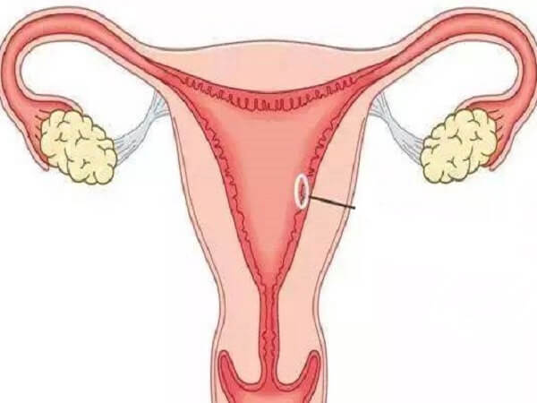 子宫内膜5毫米自然怀孕难