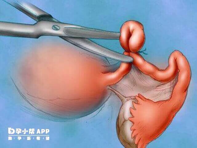 传统开腹手术方式能更精确切除子宫病灶