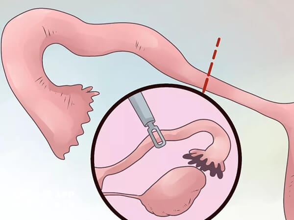 输卵管切除术一般用于治疗输卵管炎等