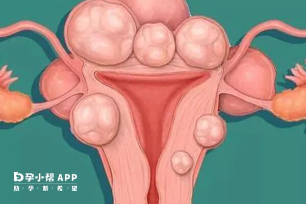 子宫肌瘤的部位和大小可能影响生育