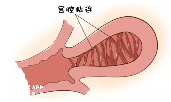 宫腔粘连多发于频繁的人流手术