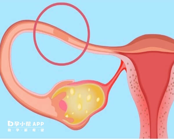 输卵管堵塞会影响生育