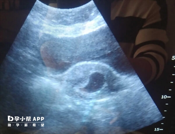 鲜胚移植后最晚4周就会有孕囊
