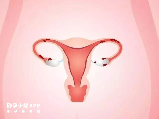 多囊卵巢容易导致排卵障碍出现不孕