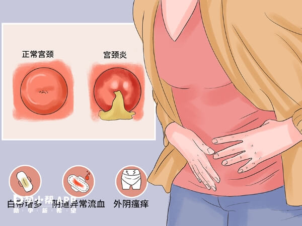 轻度宫颈炎不会影响怀孕