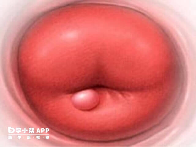 宫颈纳氏囊肿可能会影响胚胎移植