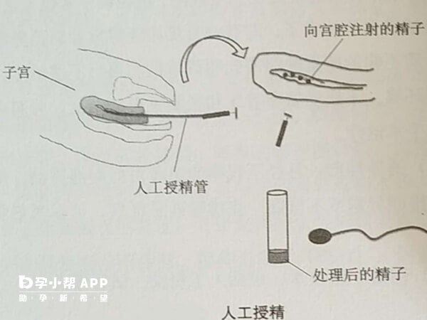 年轻且生殖健康的做人工授精容易怀孕