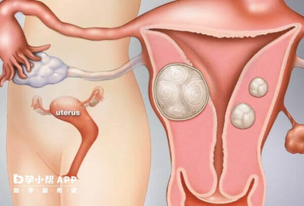 妇科疾病会影响人工授精以及怀孕