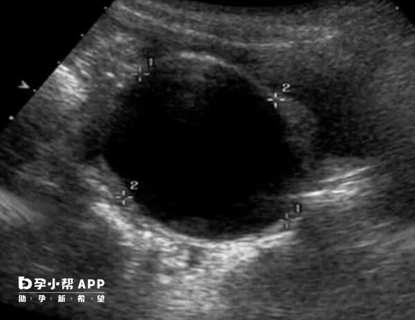 液性暗区最常见原因是胚胎暂时未着床