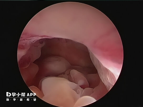 子宫内膜息肉可考虑宫腔镜手术
