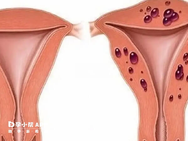 子宫腺肌症做三代试管的成功率分析