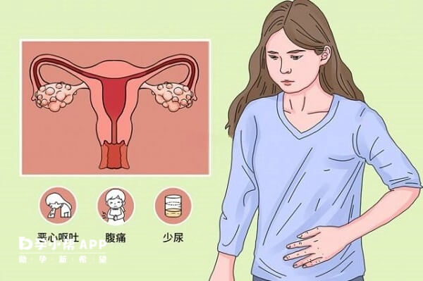 卵巢过度刺激征要暂停或取消鲜胚移植